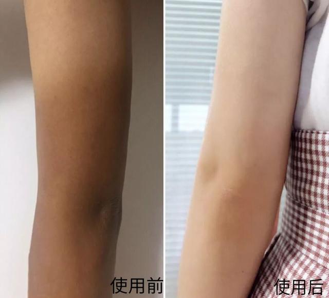 丝袜可以遮鸡皮肤吗