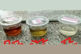 怀孕后怕光精神异常！医生曝晒尿液4小时查出真相，她得了"吸血鬼症"图片