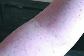 28岁女子小腿上突然密密麻麻布满红点，一查竟是得了...图片