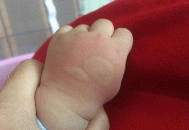 总被蚊子咬？！涂点这个马上止痒，还不花一分钱