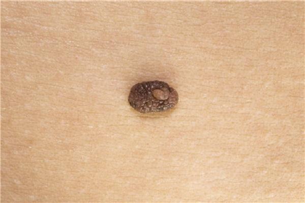 皮肤上的"小肉球"是什么?会传染吗?答案或许和你想的不一样