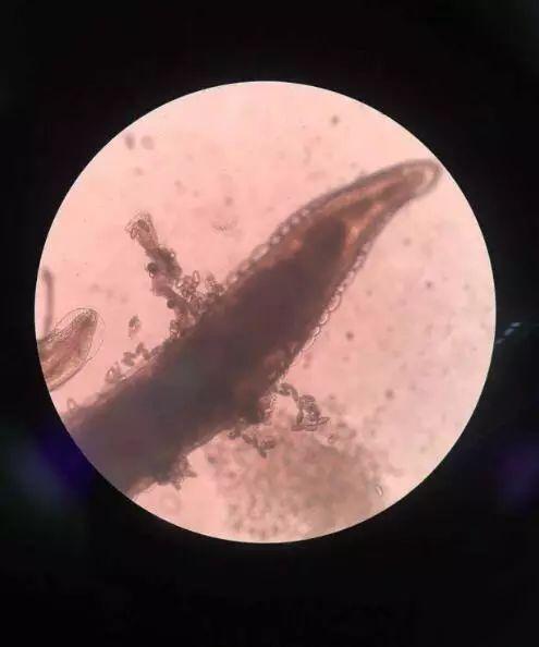 杭州4岁小女孩老喊屁屁痒,妈妈看后惊呆:许多小虫子