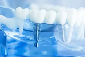 种植牙，种出老年生活的幸福之花图片