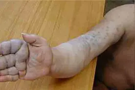 蔓状血管瘤症状及危害，读完“涨姿势”了图片