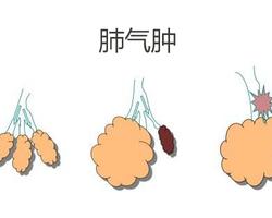 老年肺气肿吃什么药..（老年性肺气肿的症状有哪些 治疗方法有什么）
