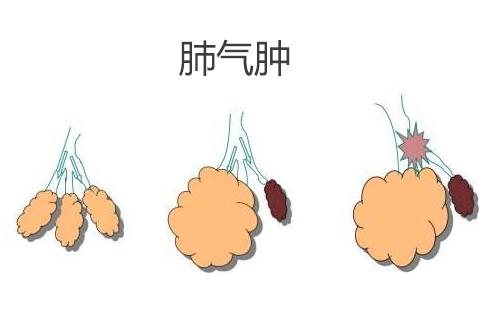 老年性肺气肿的症状有哪些 治疗方法有什么