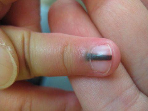 突然宝宝长了很像毛周角化