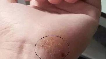 汗管角化不痛不痒吗