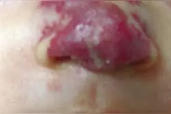血管瘤等待自消科学吗？看完这篇文章答案不言而喻图片
