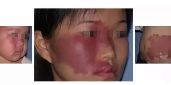 鲜红斑痣最佳治疗时间？看过后宝妈都错了