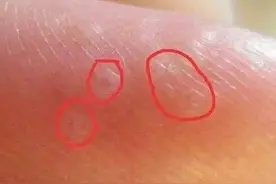 手上长透明小水泡？当心是身体发出的求救信号！图片