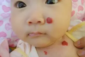 草莓状血管瘤能自愈吗？宝妈3秒读懂血管瘤图片