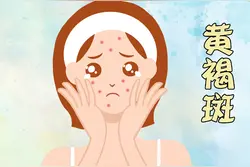 黄褐斑是怎么形成？专家：多数是这几个原因所造成图片