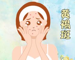 黄褐斑是怎么形成的？（黄褐斑是怎么形成专家多数是这几个原因所造成）