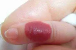 婴儿血管瘤多久消失？3秒读懂血管瘤消退问题图片