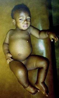 护肝，选择高支链氨基酸饮食