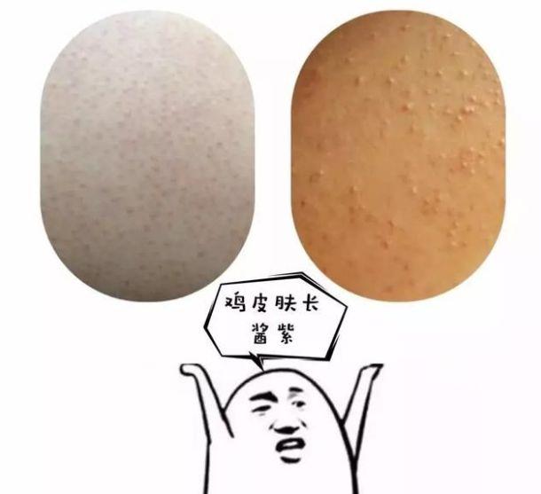胳膊上臂内侧毛囊角化会发红吗