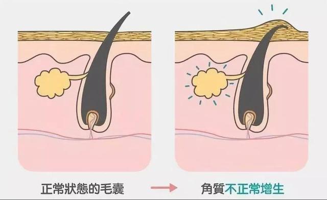 胳膊上臂内侧毛囊角化会发红吗