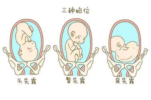 胎位不正是什么原因引起的？
