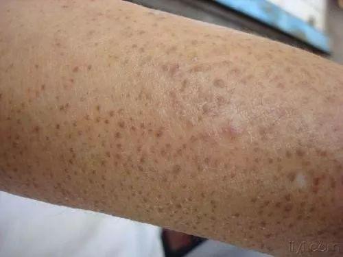 鸡皮肤黑点图片