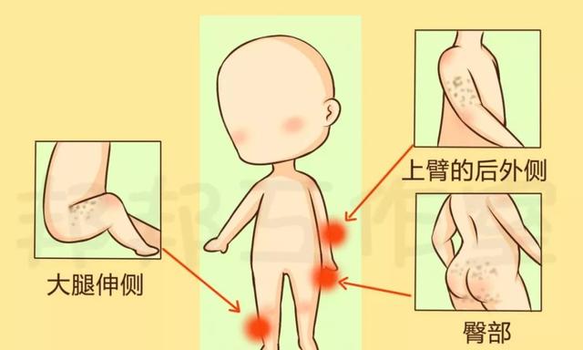 屁股上起大鸡皮疙瘩
