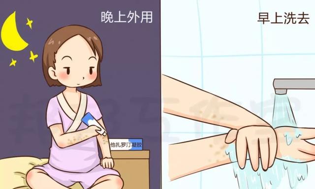 屁股上起大鸡皮疙瘩
