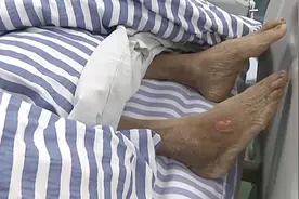 被毒蛇咬伤！63岁老伯轻信“土郎中”三副草药后送进了ICU图片