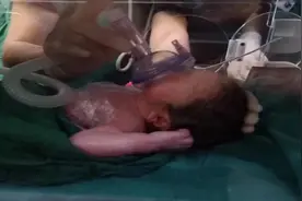 庞贝病妈妈力拒争议生子：我有生育权视频封面
