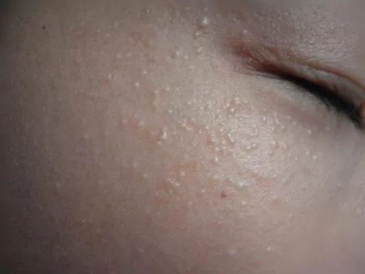 激光粟丘疹价格