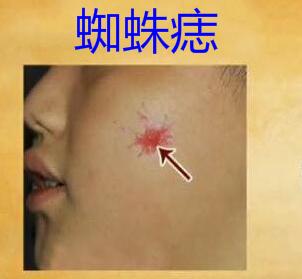 肝硬化都有哪些征兆（如何得知自己得了肝硬化五大前兆要记牢）