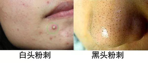 皮脂腺管角化是什么意思