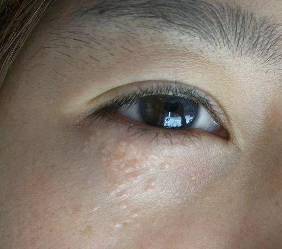 皮脂腺管角化是什么意思
