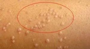 皮脂腺管角化是什么意思