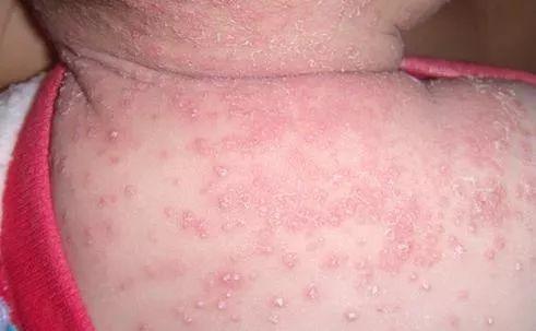 皮脂腺管角化是什么意思