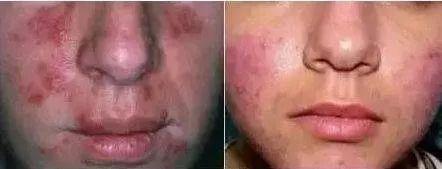 皮脂腺管角化是什么意思