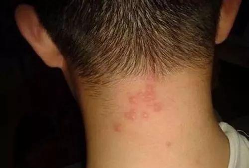 皮脂腺管角化是什么意思