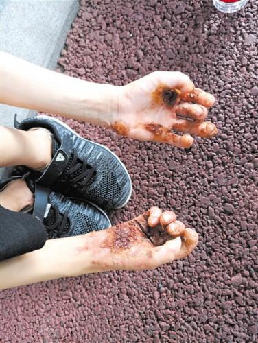 角化症能治得好吗