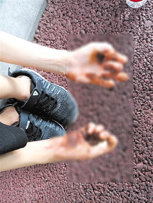 那里治疗皮肤角化症