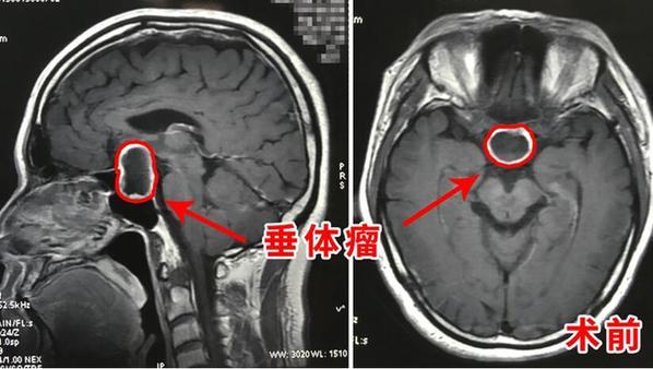 当垂体瘤遇上卒中命悬一线！通宵抢救终于转危为安