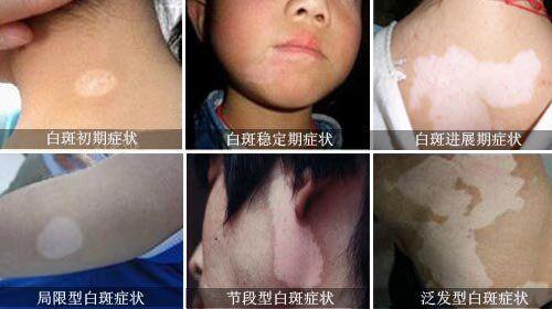 科普：白癜风的分期，你是属于哪一期呢？