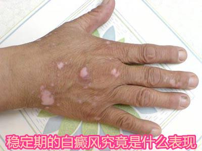 科普：白癜风的分期，你是属于哪一期呢？
