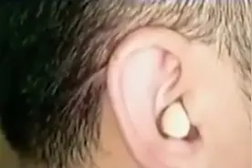 耳朵塞进大蒜能治失眠？男子模仿网红短视频，结果悲剧了！视频封面