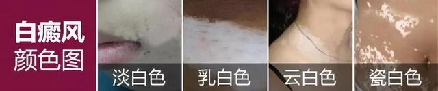 白癜风症状图片（白癜风的症状有哪些这四个颜色暗示一定要知道）