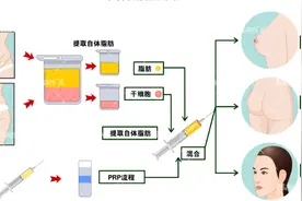 大腿吸脂如何选择？芒果吸脂能解决吗？图片