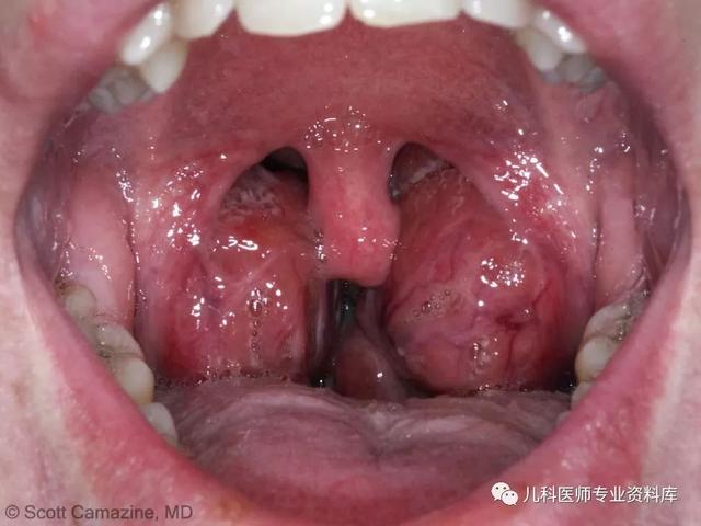 扁桃体都化脓了，为什么不用抗生素？一用抗生素就得满10天吗？