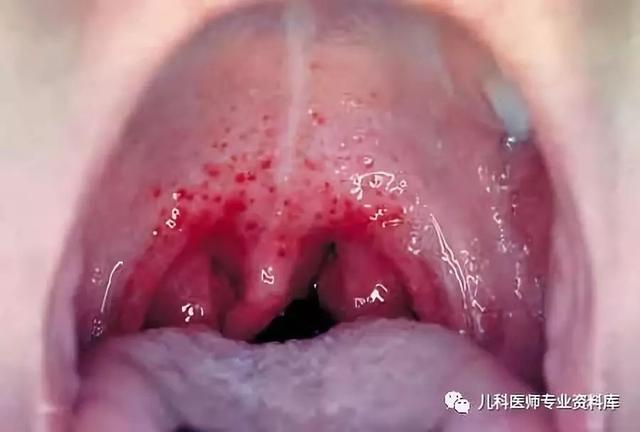 扁桃体都化脓了，为什么不用抗生素？一用抗生素就得满10天吗？