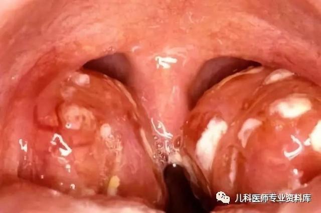 扁桃体都化脓了，为什么不用抗生素？一用抗生素就得满10天吗？
