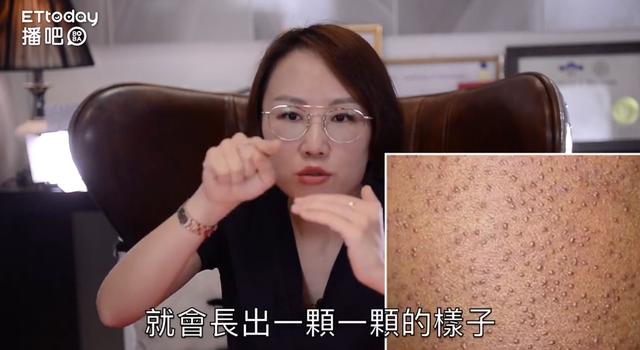 毛周角化症的脸部皮肤