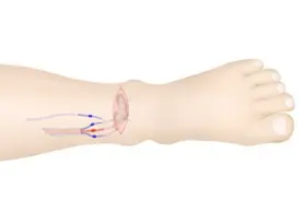 女子宫颈癌术后成“象腿”，湘雅专家创新术式击退淋巴水肿图片