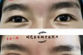想割个双眼皮但又有顾虑 专家为您答疑解惑图片